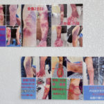 腕の打撲による内出血、腫れの経過